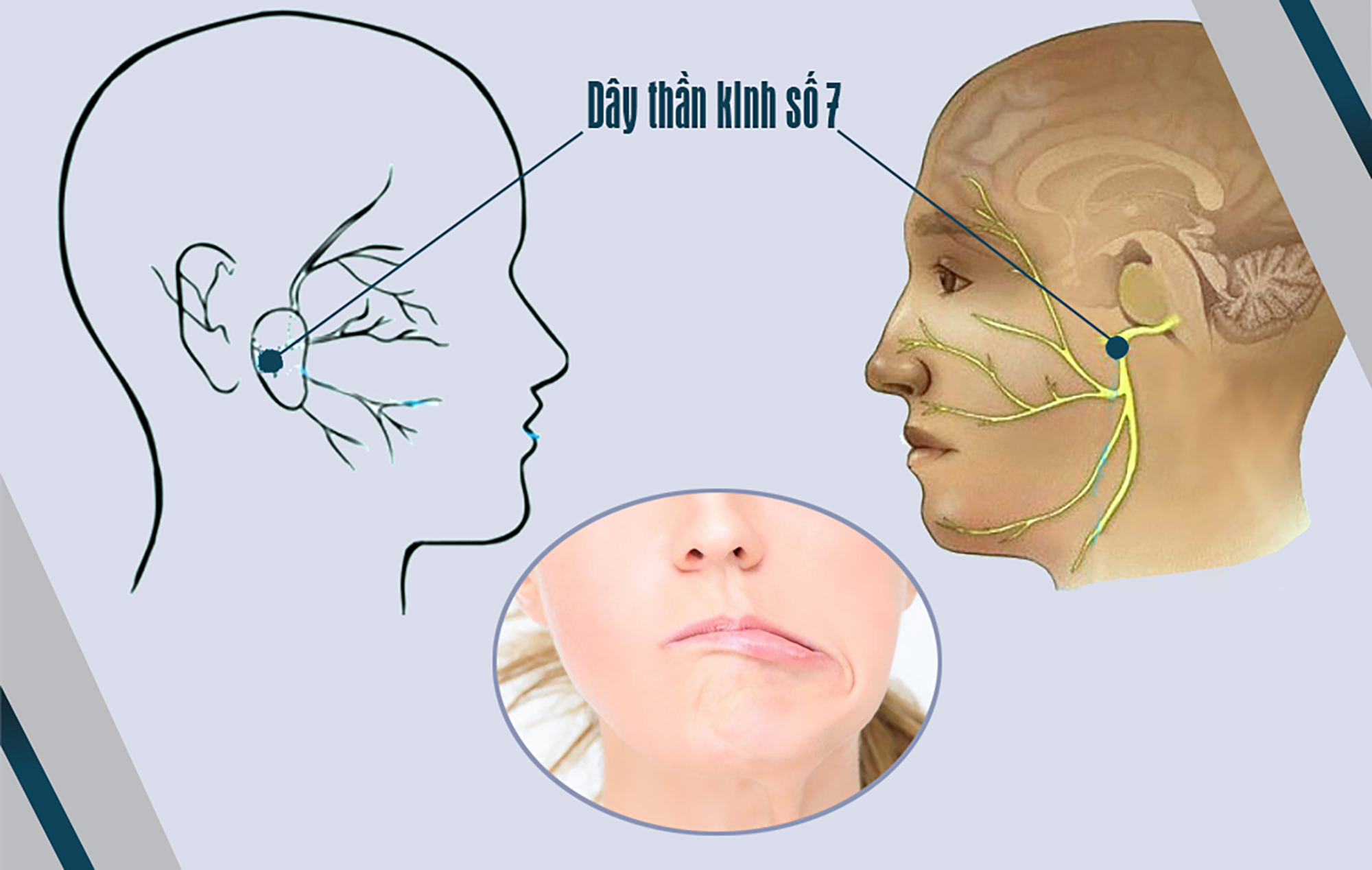 Phòng ngừa liệt dây thần kinh số 7 cách nào?- Ảnh 1. Phòng ngừa liệt dây thần kinh số 7 cách nào?- Ảnh 1.