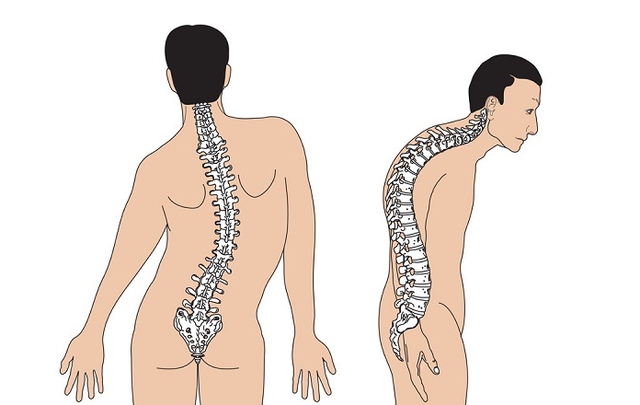 Thanh niên 19 tuổi bất ngờ phát hiện cột sống cong 50 độ, thừa nhận thường xuyên làm việc này trong lúc tập gym - Ảnh 3. Thanh niên 19 tuổi bất ngờ phát hiện cột sống cong 50 độ, thừa nhận thường xuyên làm việc này trong lúc tập gym - Ảnh 3.
