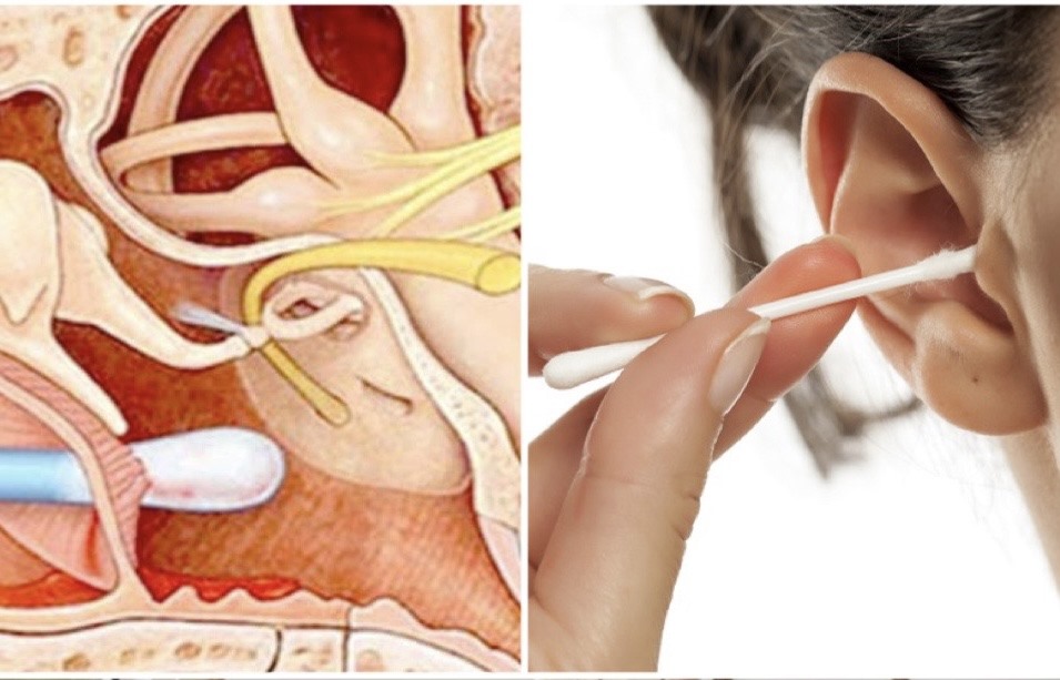 Người đàn ông đau nhức, phải đến viện do sai lầm nhiều người hay mắc khi lấy ráy tai- Ảnh 2. Người đàn ông đau nhức, phải đến viện do sai lầm nhiều người hay mắc khi lấy ráy tai- Ảnh 2.