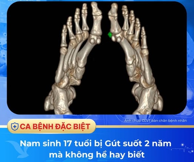 Bất ngờ nam sinh 17 tuổi ở Hà Nội mắc bệnh Gút suốt 2 năm mà không hề hay biết - Ảnh 2. Bất ngờ nam sinh 17 tuổi ở Hà Nội mắc bệnh Gút suốt 2 năm mà không hề hay biết - Ảnh 2.