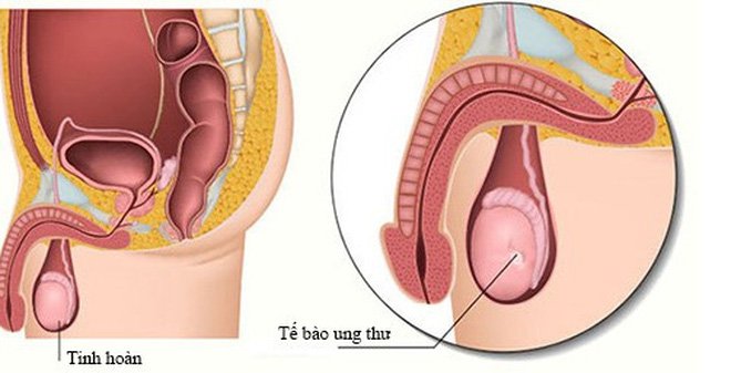 Bé trai 11 tuổi đã mắc ung thư tinh hoàn, chuyên gia cảnh báo dấu hiệu phát hiện sớm bệnh - Ảnh 1. Bé trai 11 tuổi đã mắc ung thư tinh hoàn, chuyên gia cảnh báo dấu hiệu phát hiện sớm bệnh - Ảnh 1.