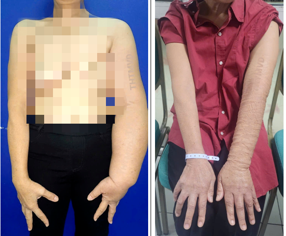 Giải phóng cho người phụ nữ bị phù tay voi sau phẫu thuật ung thư vú - Ảnh 1. Giải phóng cho người phụ nữ bị phù tay voi sau phẫu thuật ung thư vú - Ảnh 1.