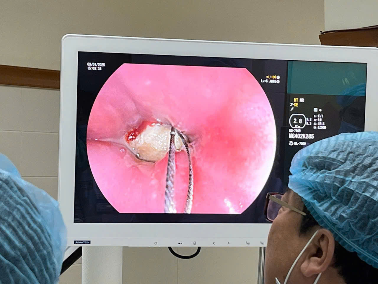 Mắc xương heo trong cổ khi ăn cháo, người đàn ông khó thở phải cấp cứu- Ảnh 1. mắc xương heo
