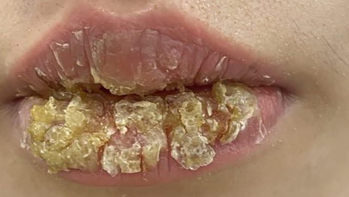 Môi biến dạng, chảy dịch sau khi xăm môi thẩm mỹ - Ảnh 1. Môi biến dạng, chảy dịch sau khi xăm môi thẩm mỹ - Ảnh 1.