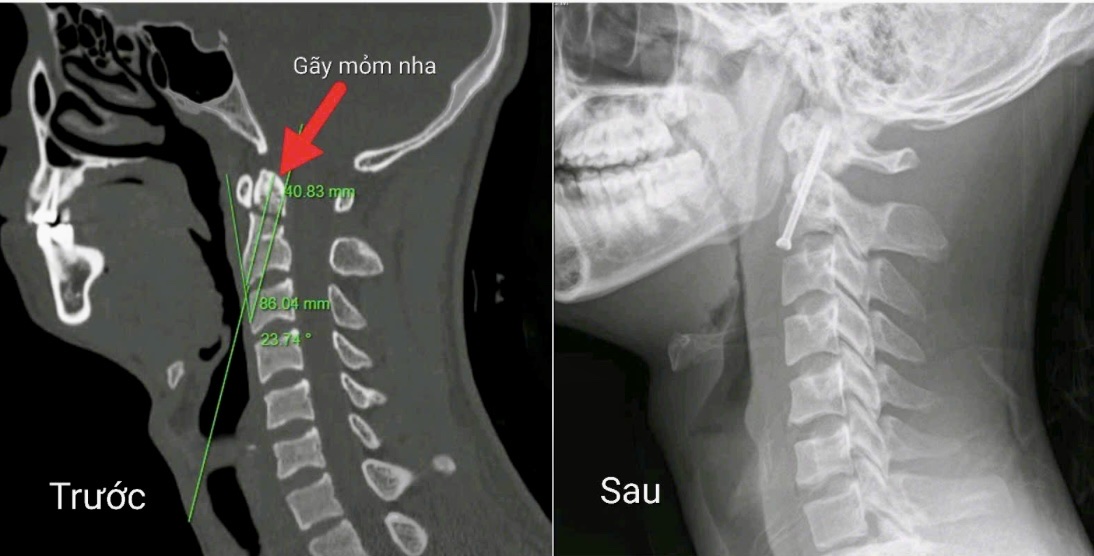 Phẫu thuật nội soi điều trị thành công ca gãy cột sống cổ phức tạp- Ảnh 1. Phẫu thuật nội soi điều trị thành công ca gãy cột sống cổ phức tạp- Ảnh 1.